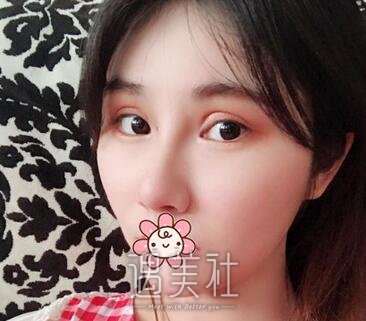高志丹,隆鼻