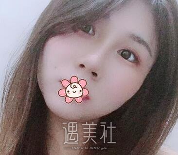 高志丹,隆鼻