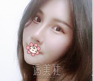 高志丹,隆鼻