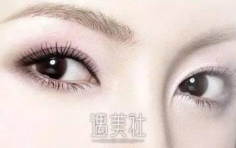 定位双眼皮