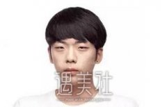 男士综合隆鼻案例：男孩子一样可以做隆鼻手术哦 width=