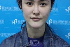 王绍国下巴取出案例：术后60天果反馈~ width=