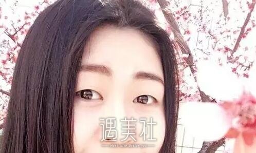 宋宝强做双眼皮自然嘛，有没有宋宝强近期案例分享?