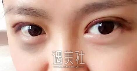 宋宝强做双眼皮自然嘛，有没有宋宝强近期案例分享?
