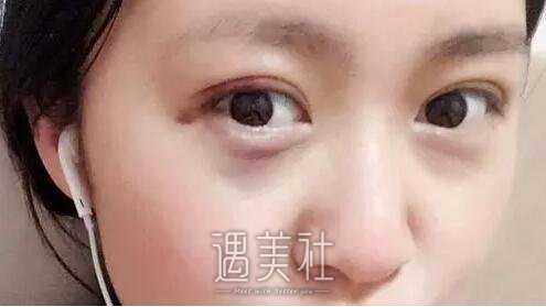 宋宝强做双眼皮自然嘛，有没有宋宝强近期案例分享?
