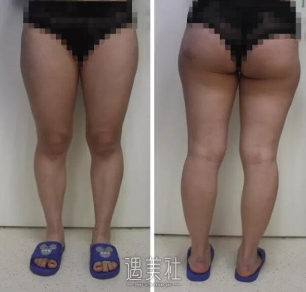 360度环形吸脂果好不好，真实案例分享哦~