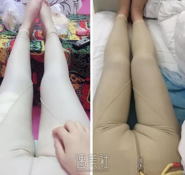 360度环形吸脂果好不好，真实案例分享哦~