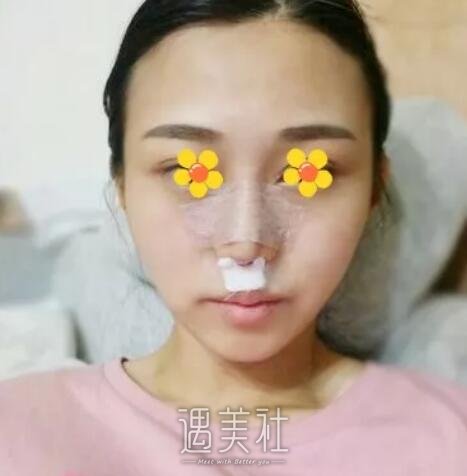 南京沈干做鼻子好不好，前几个月做了现在炒鸡自然~
