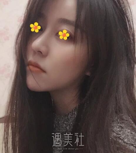 南京沈干做鼻子好不好，前几个月做了现在炒鸡自然~