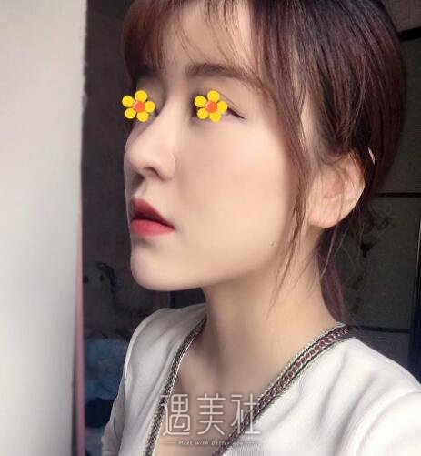 南京沈干做鼻子好不好，前几个月做了现在炒鸡自然~