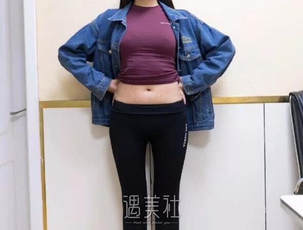 腰腹环吸亲身经历：不用锻炼就能减肥感脚炒鸡棒~