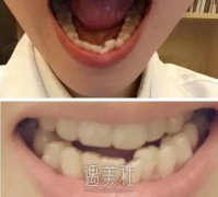 找袁志杰医生给我做了牙齿矫正，现在随时都是笑得灿烂~ width=