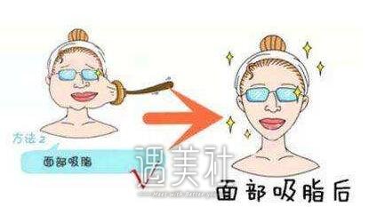 做了脸部吸脂手术会反弹吗?果大概能维持多久呢?