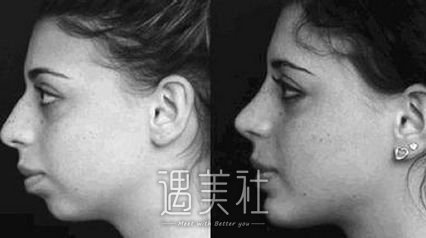做了脸部吸脂手术会反弹吗?果大概能维持多久呢?