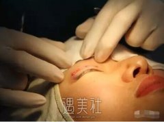 仁济医院皮庆猛双眼皮案例：看来单眼皮确实不适合我! width=