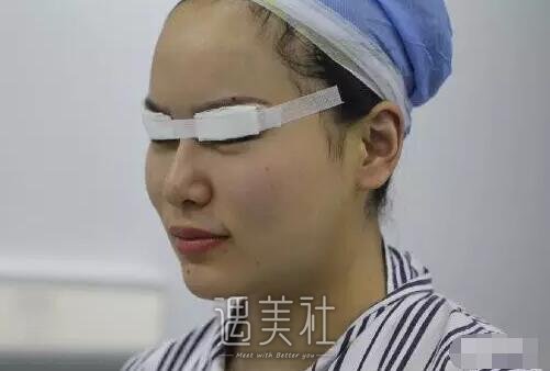 仁济医院皮庆猛双眼皮案例：看来单眼皮确实不适合我!