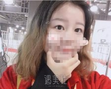 上海九院范先群双眼皮案例：范医生技术真的很棒啊～ width=