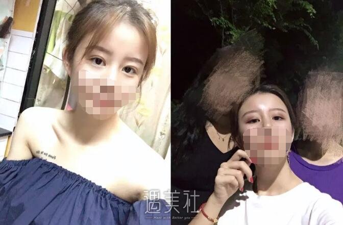 上海九院范先群双眼皮案例：范医生技术真的很棒啊～