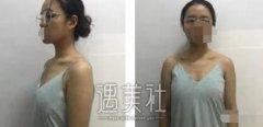 上海九院章一新隆胸案例：一开始的顾虑是多余了～ width=