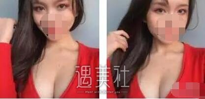 上海九院章一新隆胸案例：一开始的顾虑是多余了～