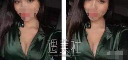 上海九院章一新隆胸案例：一开始的顾虑是多余了～