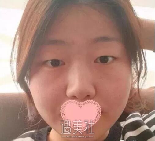 九院王丹茹双眼皮案例：我爸看了都有想做的冲动!