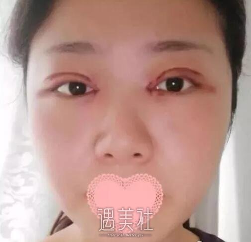 九院王丹茹双眼皮案例：我爸看了都有想做的冲动!