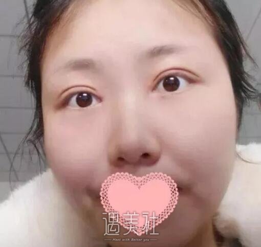 九院王丹茹双眼皮案例：我爸看了都有想做的冲动!