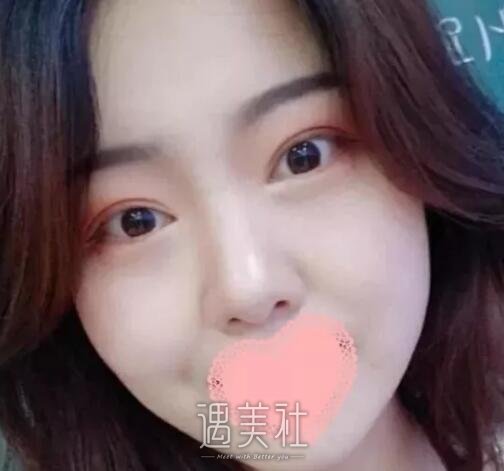 九院王丹茹双眼皮案例：我爸看了都有想做的冲动!