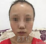 中日友好医院高占巍隆鼻案例：鼻子高挺了朋友也多了～ width=