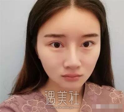 中日友好医院高占巍面部轮廓整形案例，来看看哇～
