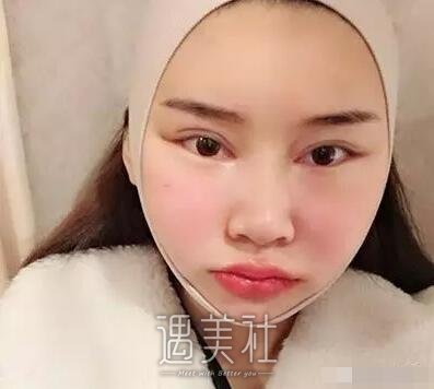 中日友好医院高占巍面部轮廓整形案例，来看看哇～