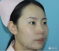 中日友好医院齐彦文双眼皮案例：这才是真实的我! width=