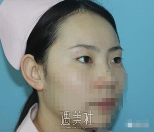 中日友好医院齐彦文双眼皮案例：这才是真实的我!