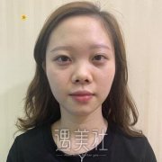 北京八大处周栩隆鼻案例分享，还有恢复前后照片供欣赏~ width=