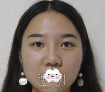 冯思阳鼻部手术手术技术怎么样？这有一则案例分享哦~ width=