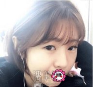 刘世铭给我做的双眼皮，现在恢复得相当自然，来瞧瞧！ width=