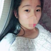 天津维美整形医院双眼皮案例：很感激助我重拾青春和自信～ width=