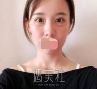 江小美整形去眼袋三个月案例分享：术后恢复全纪录~ width=