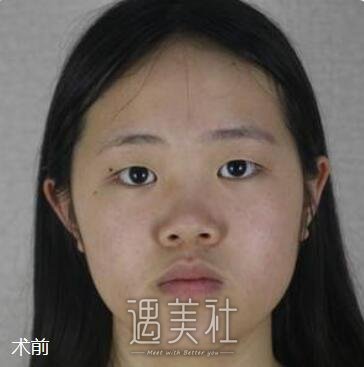 成都,西区,隆鼻