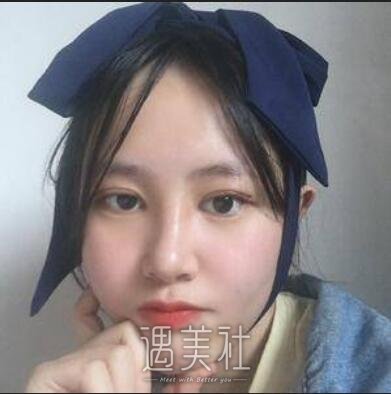 成都,西区,隆鼻