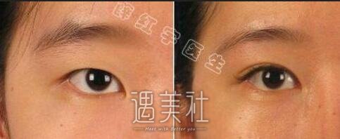 北医三院,薛红宇