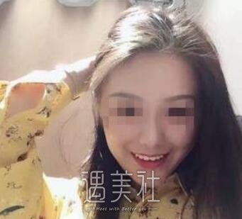 金敬雅,玻尿酸,丰太阳穴