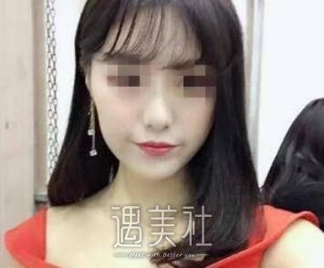 金敬雅,玻尿酸,丰太阳穴