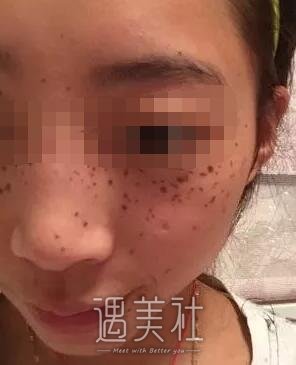 找长春中妍窦颖做了祛雀斑，脸上干干净净的就是好啊~