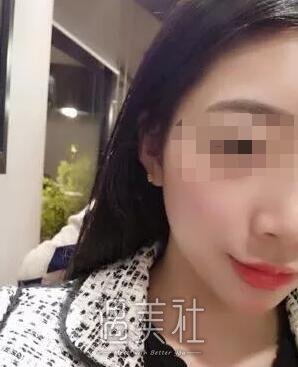 找长春中妍窦颖做了祛雀斑，脸上干干净净的就是好啊~