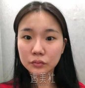 成都素美杨迪割双眼皮案例：这样的大眼睛请给我一打! width=