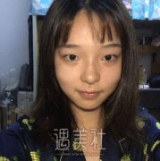 成都铜雀台割双眼皮技术怎么样?有真实案例力证吗? width=