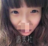 成都素美帕克双眼皮案例：果这么好不火都难啊! width=