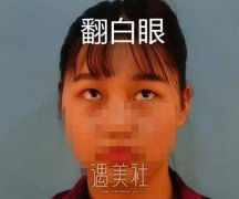 武警医院蒋亚楠给我做的双眼皮，目前恢复得灰常不错~ width=